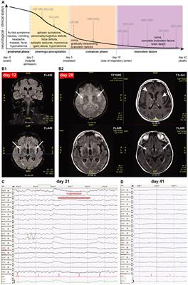 Case report: Fatal Borna virus encephalitis manifesting with basal brain and brainstem symptoms